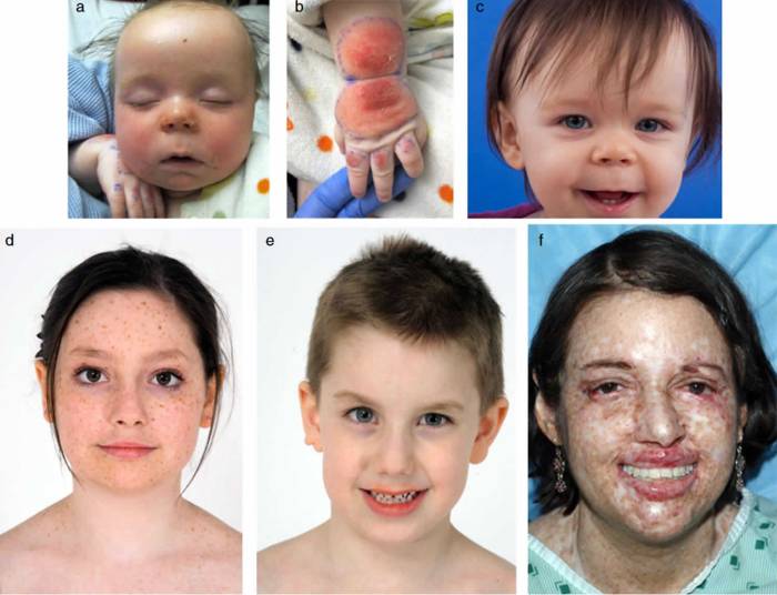 Xeroderma pigmentosum xp causes figure treatment Penyakit xeroderma pigmentosum