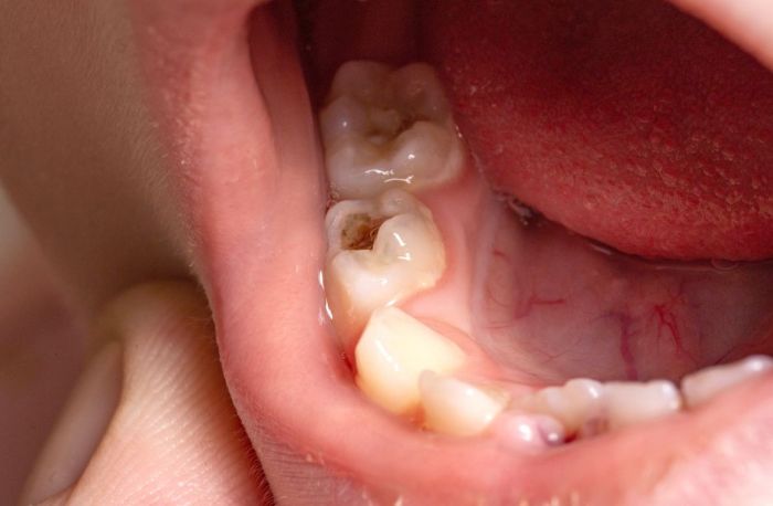 Gigi depan menambal renggang dokter sederhana secara Cara menambal gigi berlubang