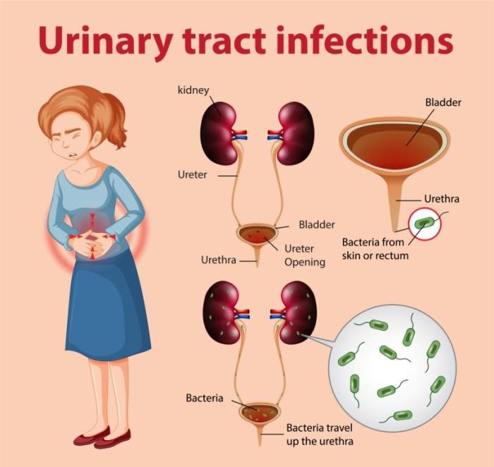 Urinary tract uti infections menopause bladder urination symptom diagnosis verywell ferster verywellhealth Cara mengatasi anyang anyangan